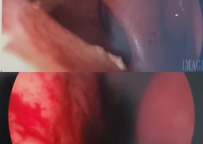 Female Septal Perforation Before and After
