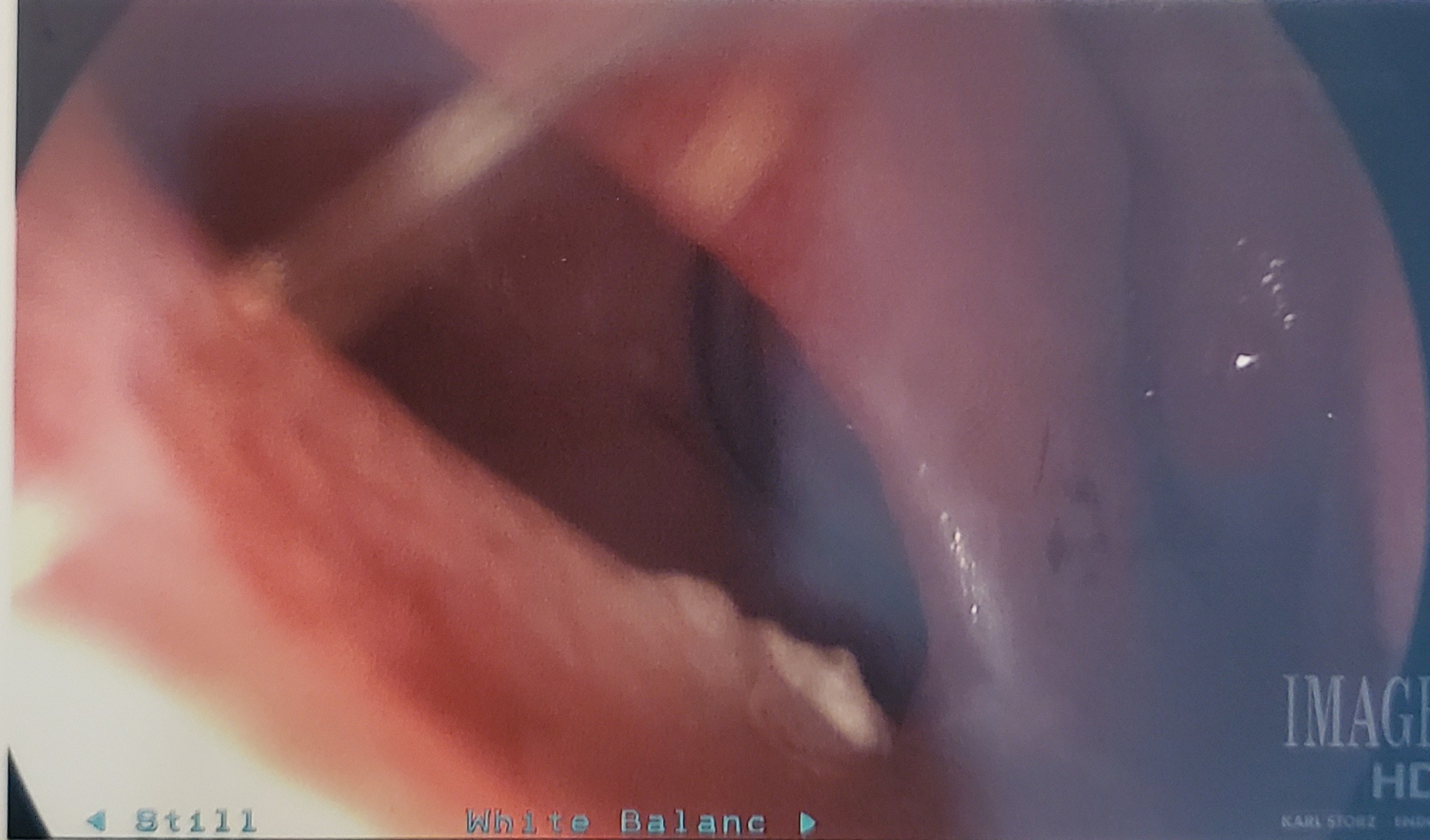 Female Septal Perforation Before and After Female Septal Perforation Before and After