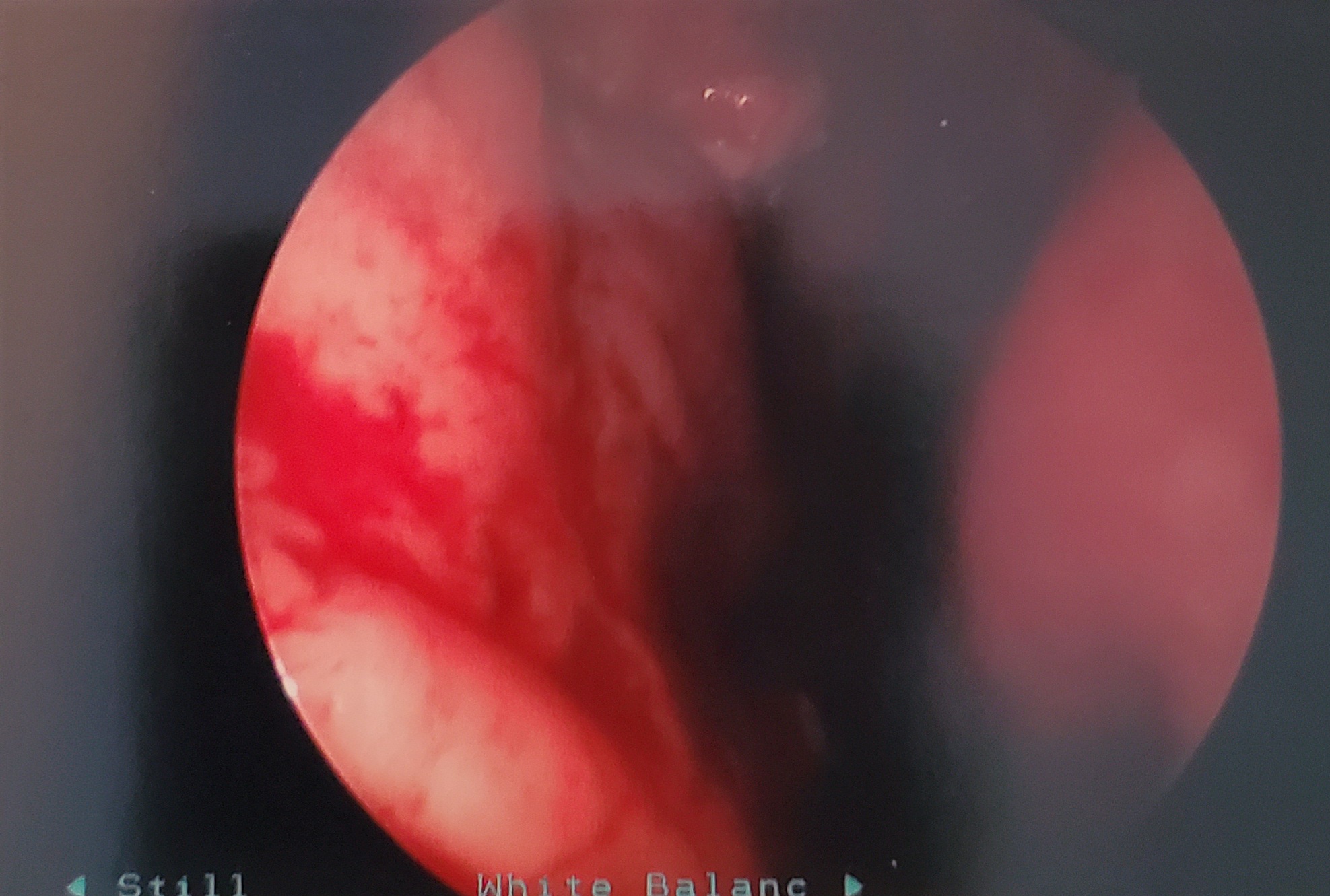 Female Septal Perforation Before and After Female Septal Perforation Before and After