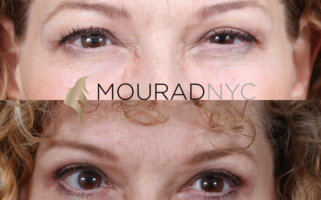 Female Blepharoplasty Before and After
