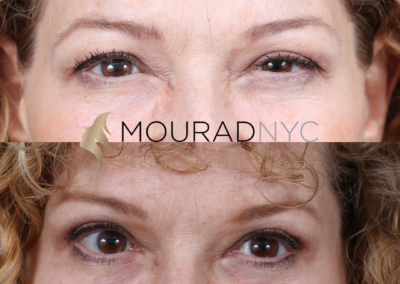 Female Blepharoplasty Before and After
