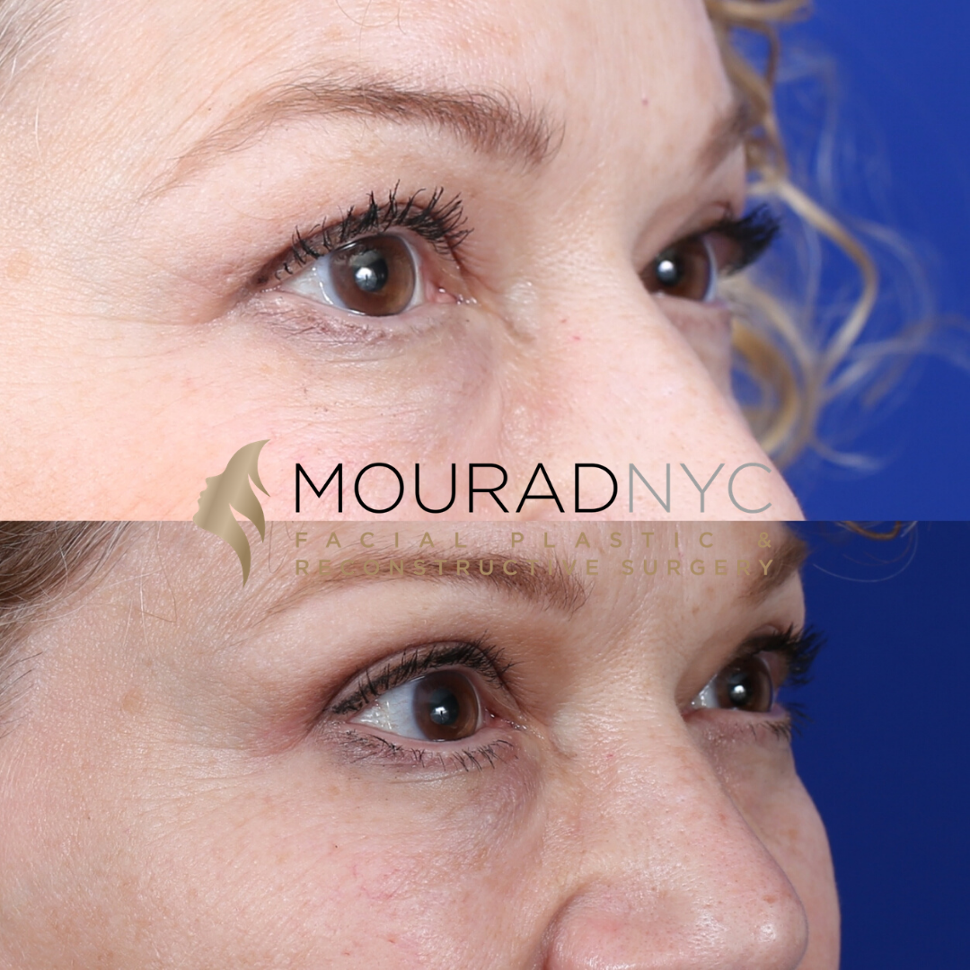 Female Blepharoplasty Before and After Female Blepharoplasty Before and After