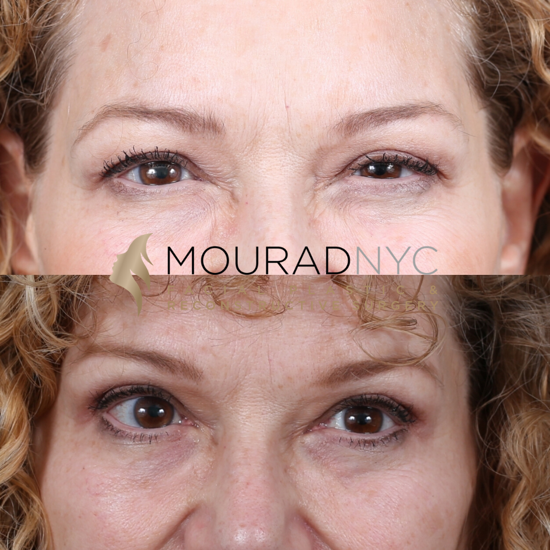 Female Blepharoplasty Before and After Female Blepharoplasty Before and After