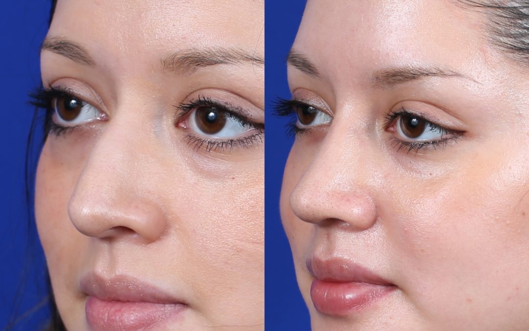 Female Closed Rhinoplasty Before and After