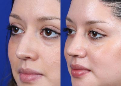 Female Closed Rhinoplasty Before and After