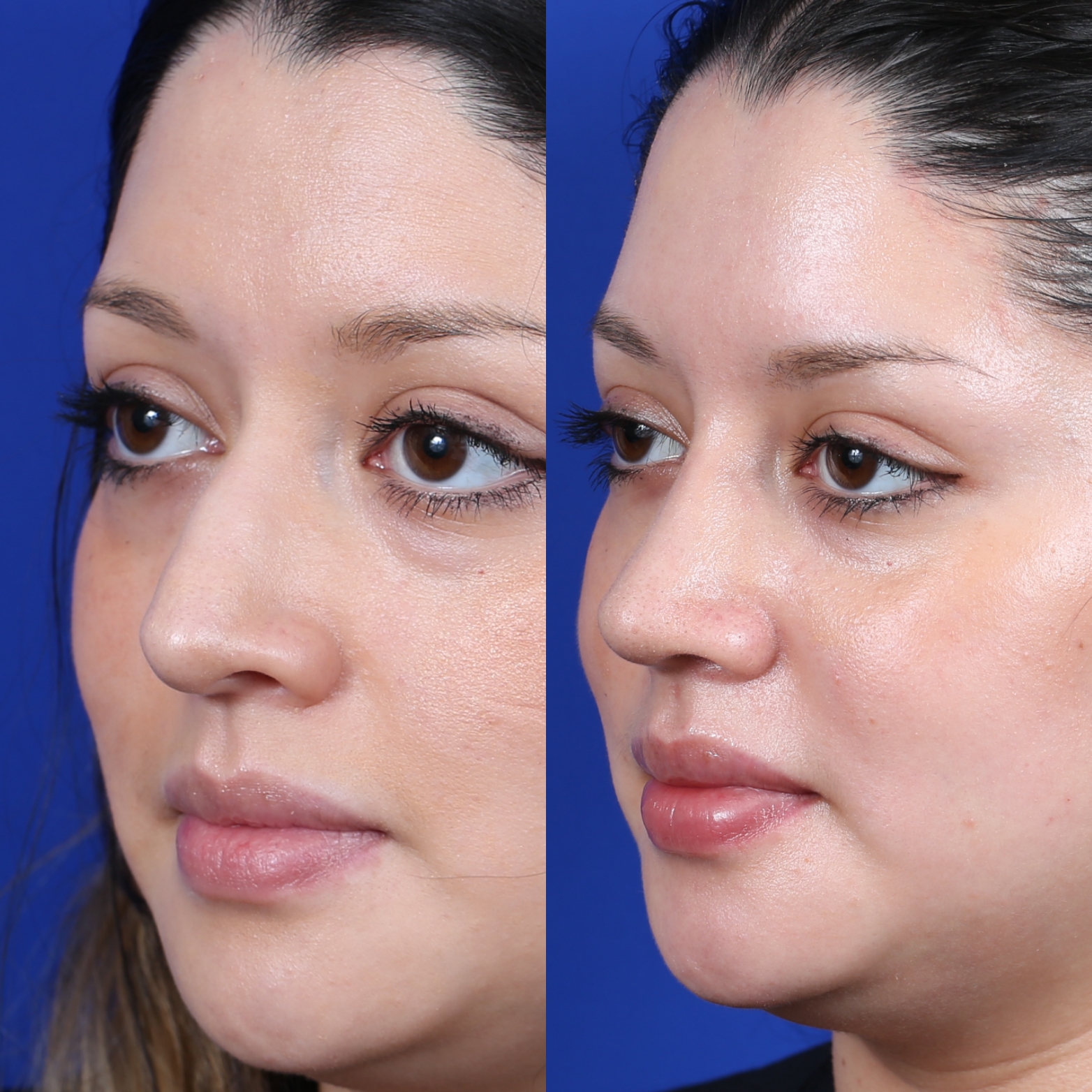 Female Closed Rhinoplasty Before and After Female Closed Rhinoplasty Before and After