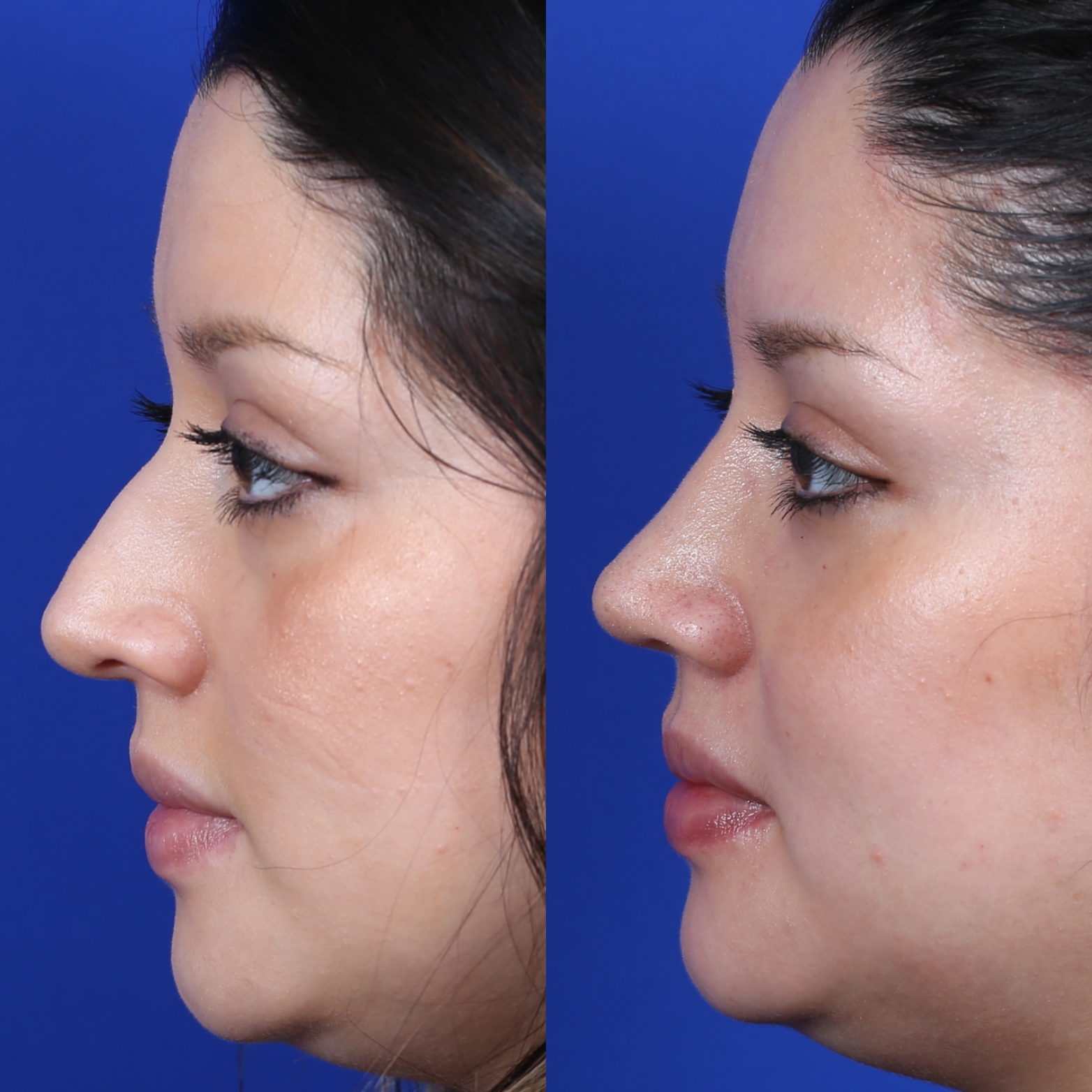 Female Closed Rhinoplasty Before and After Female Closed Rhinoplasty Before and After