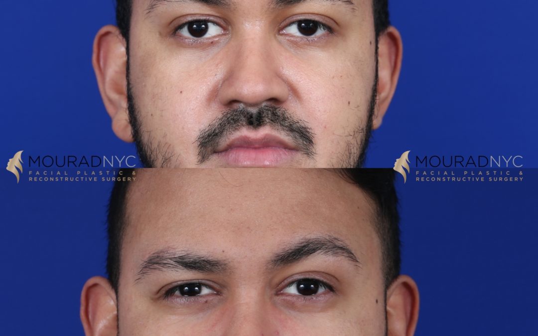 Male Brow Lift Before and After