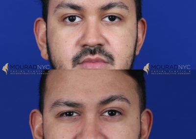 Male Brow Lift Before and After