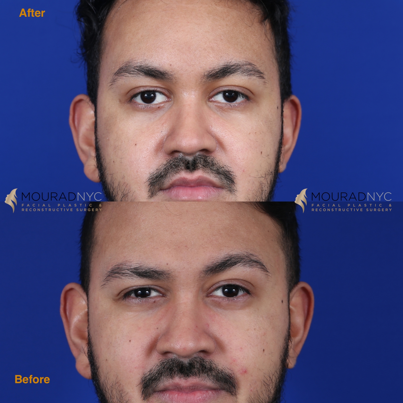 Male Brow Lift Before and After Male Brow Lift Before and After