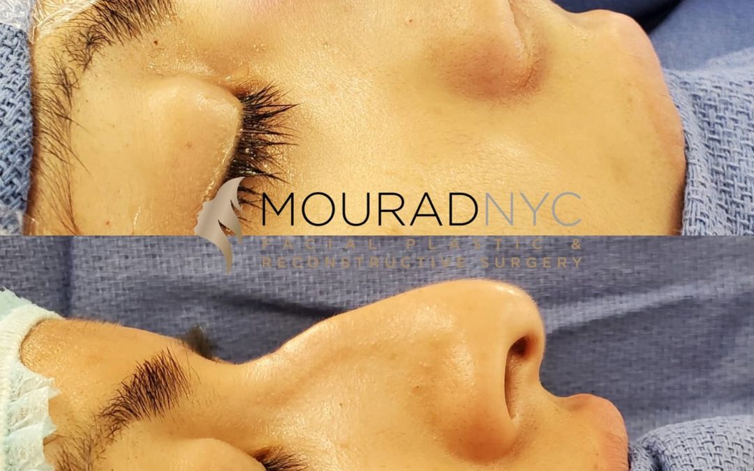 Female Open Rhinoplasty Before and After