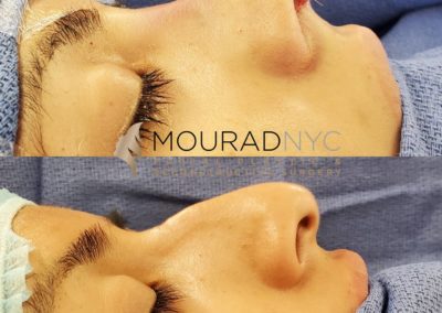 Female Open Rhinoplasty Before and After