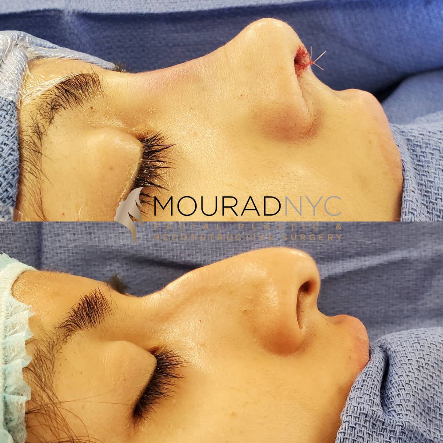Female Open Rhinoplasty Before and After Female Open Rhinoplasty Before and After