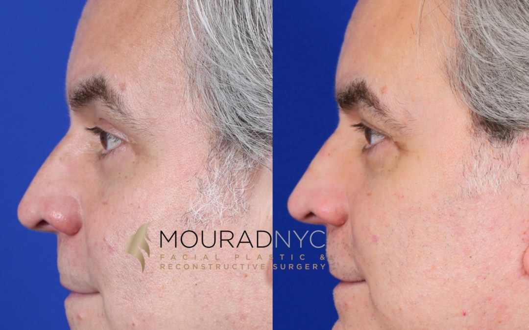 Male Facelift And Necklift Before And After