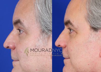 Male Facelift And Necklift Before And After