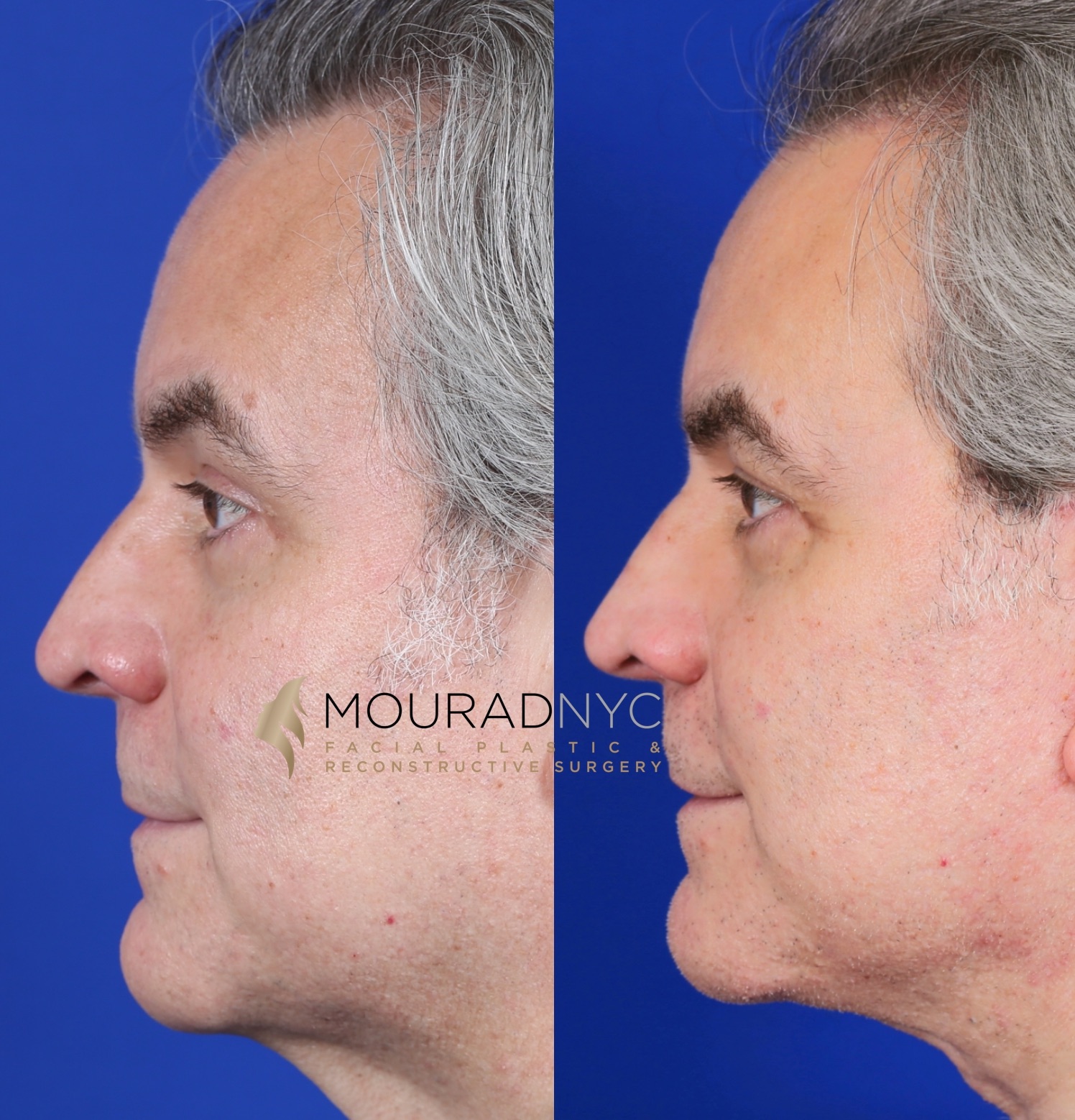 Male Facelift And Necklift Before And After Male Facelift And Necklift Before And After