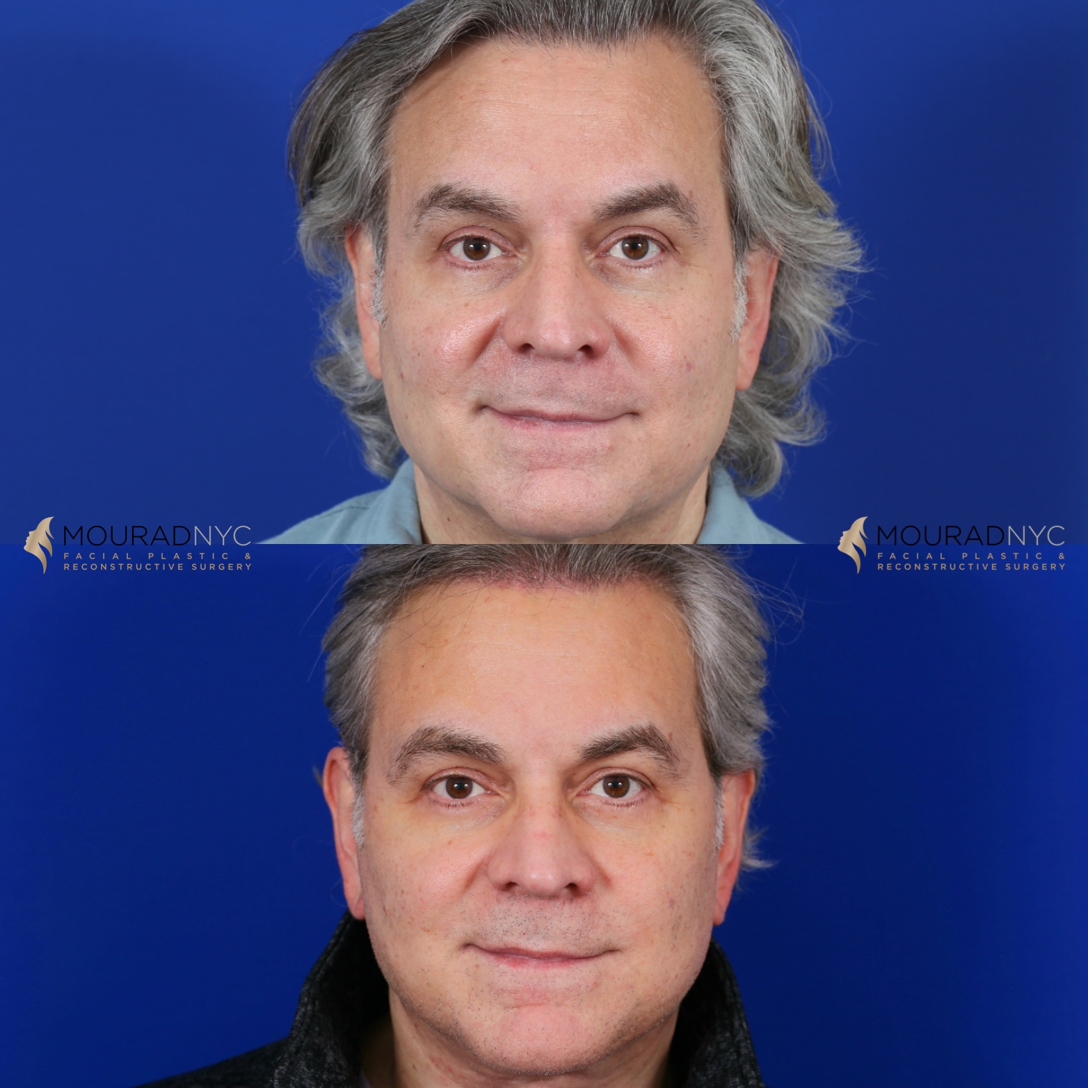 Male Facelift And Necklift Before And After Male Facelift And Necklift Before And After