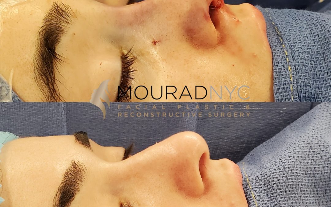 Female Open Rhinoplasty Before and After