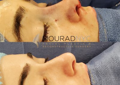 Female Open Rhinoplasty Before and After