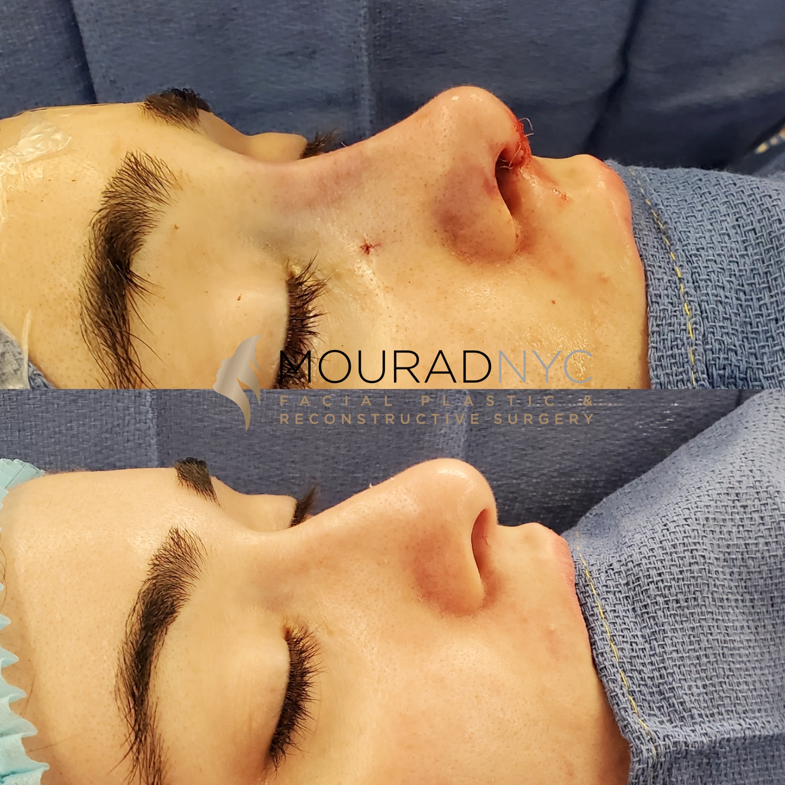 Female Open Rhinoplasty Before and After Female Open Rhinoplasty Before and After