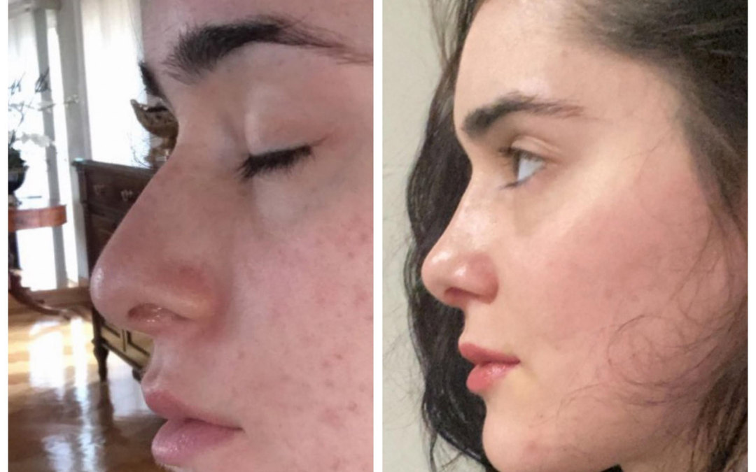Female Open Rhinoplasty Before and After