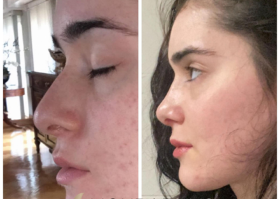 Female Open Rhinoplasty Before and After