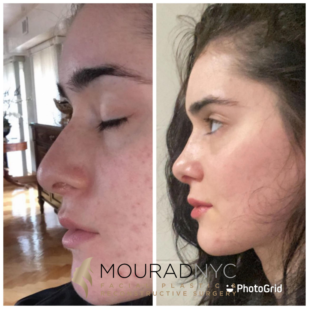 Female Open Rhinoplasty Before and After Female Open Rhinoplasty Before and After