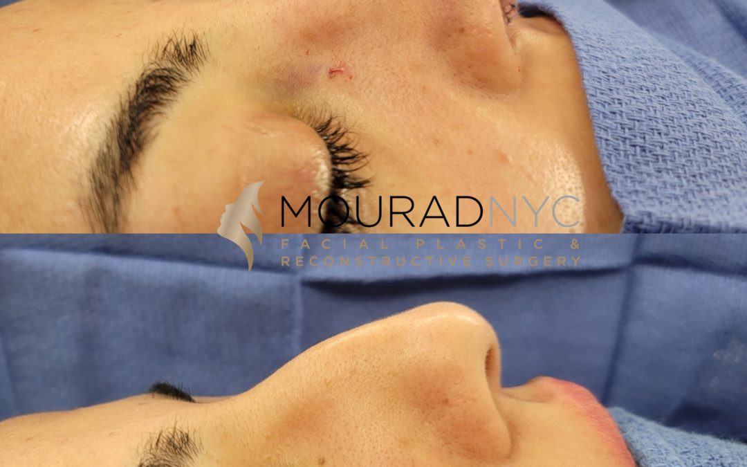 Female Open Rhinoplasty Before and After