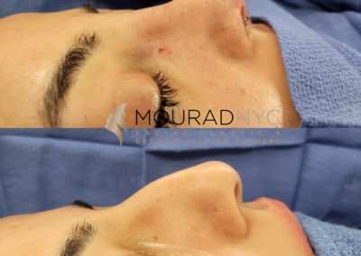 Female Open Rhinoplasty Before and After