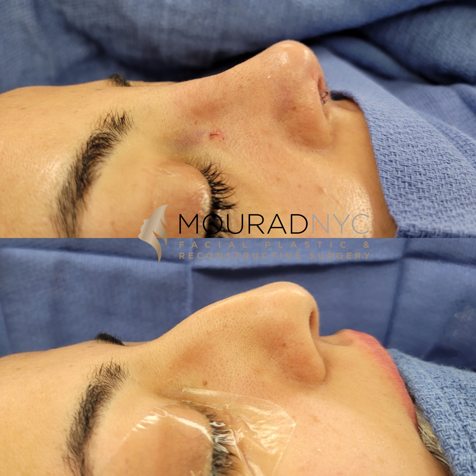 Female Open Rhinoplasty Before and After Female Open Rhinoplasty Before and After