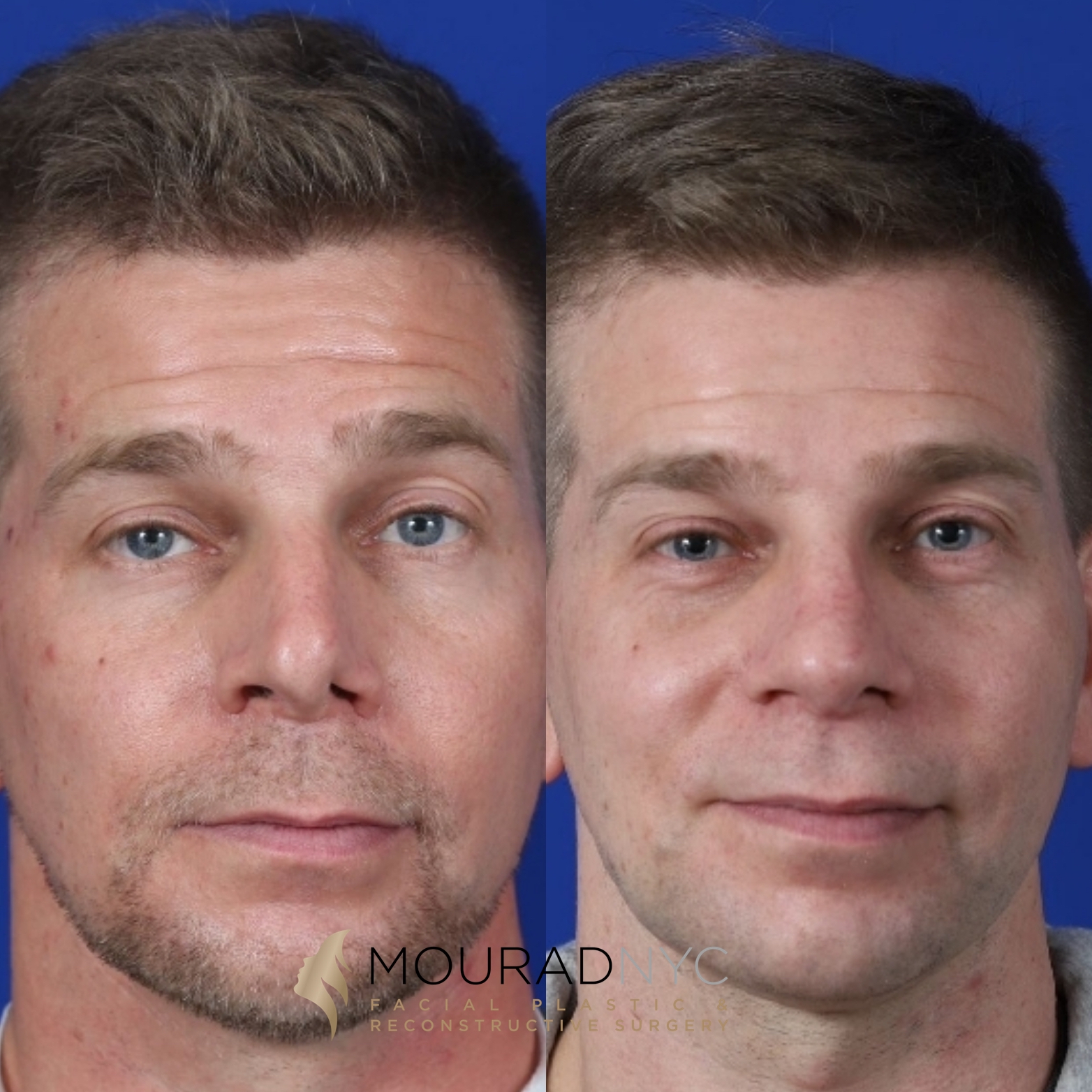Male Revision Rhinoplasty Before and After Male Revision Rhinoplasty Before and After