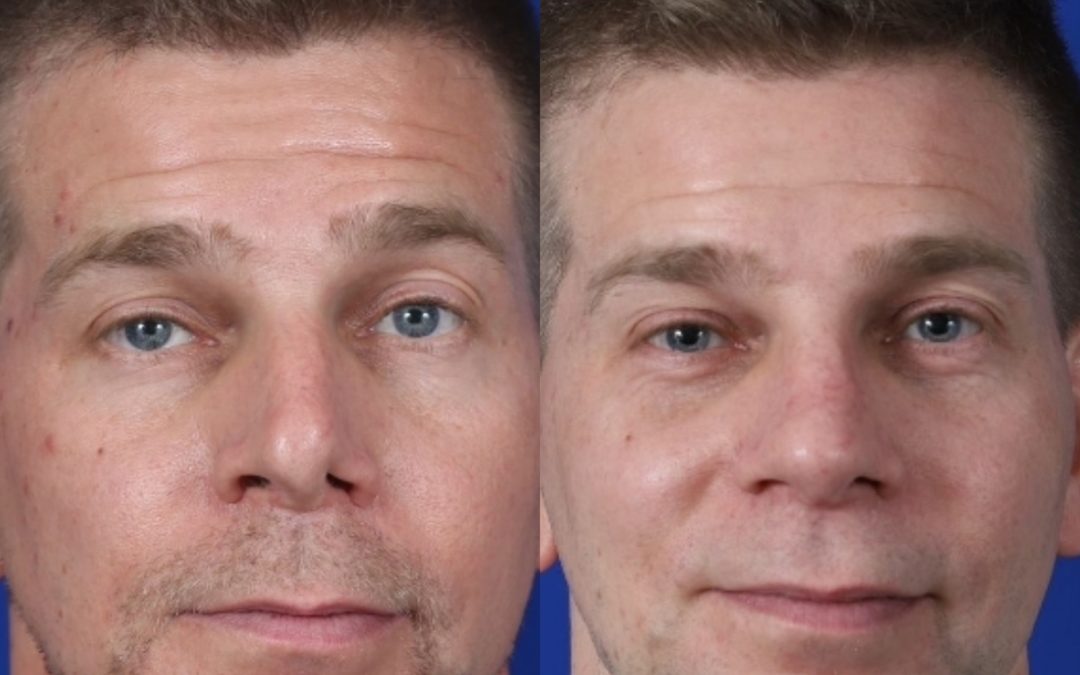 Male Revision Rhinoplasty Before and After