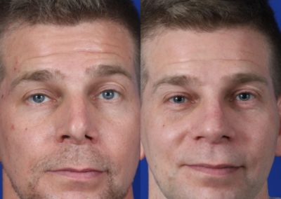 Male Revision Rhinoplasty Before and After