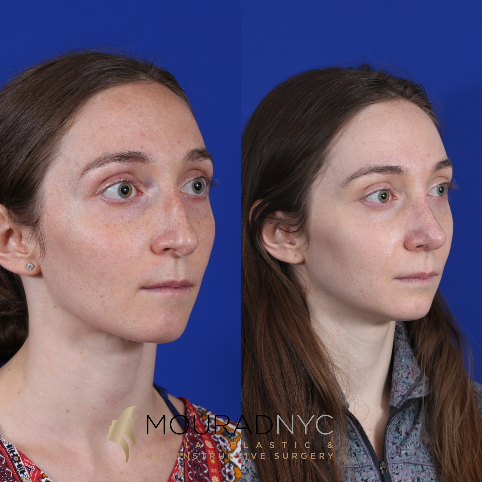 Female Closed Rhinoplasty Before and After Female Closed Rhinoplasty Before and After