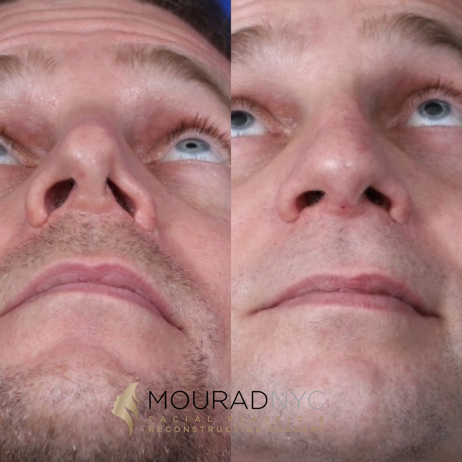 Male Revision Rhinoplasty Before and After Male Revision Rhinoplasty Before and After
