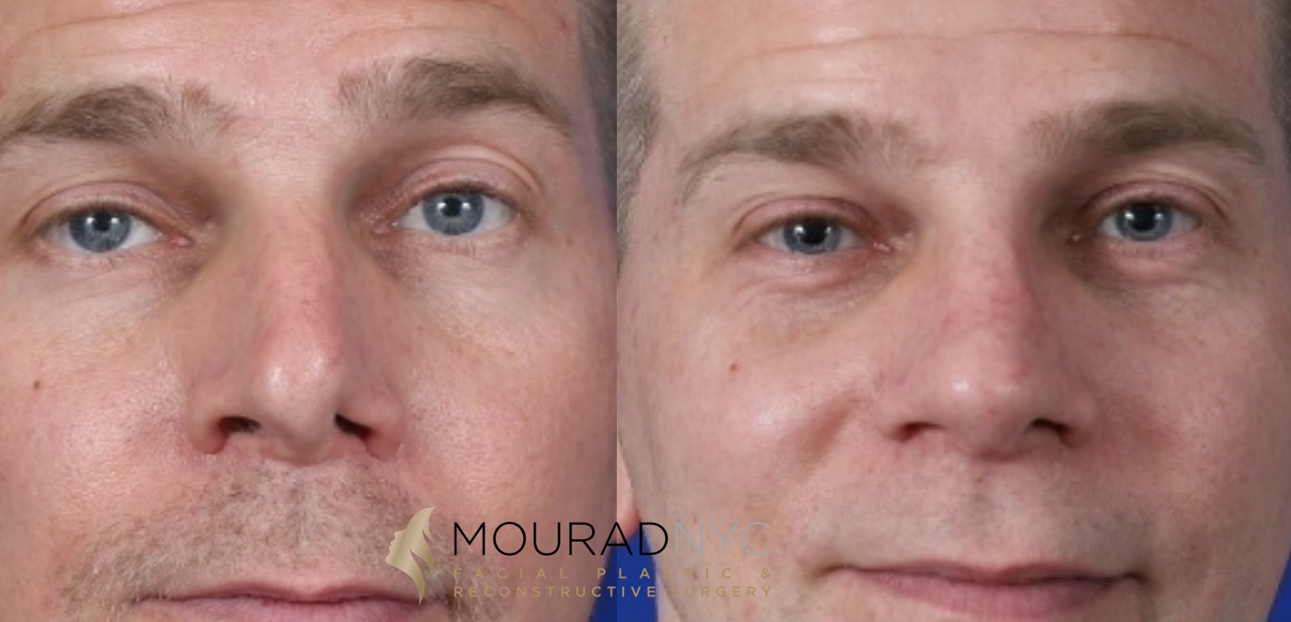 Male Revision Rhinoplasty Before and After Male Revision Rhinoplasty Before and After