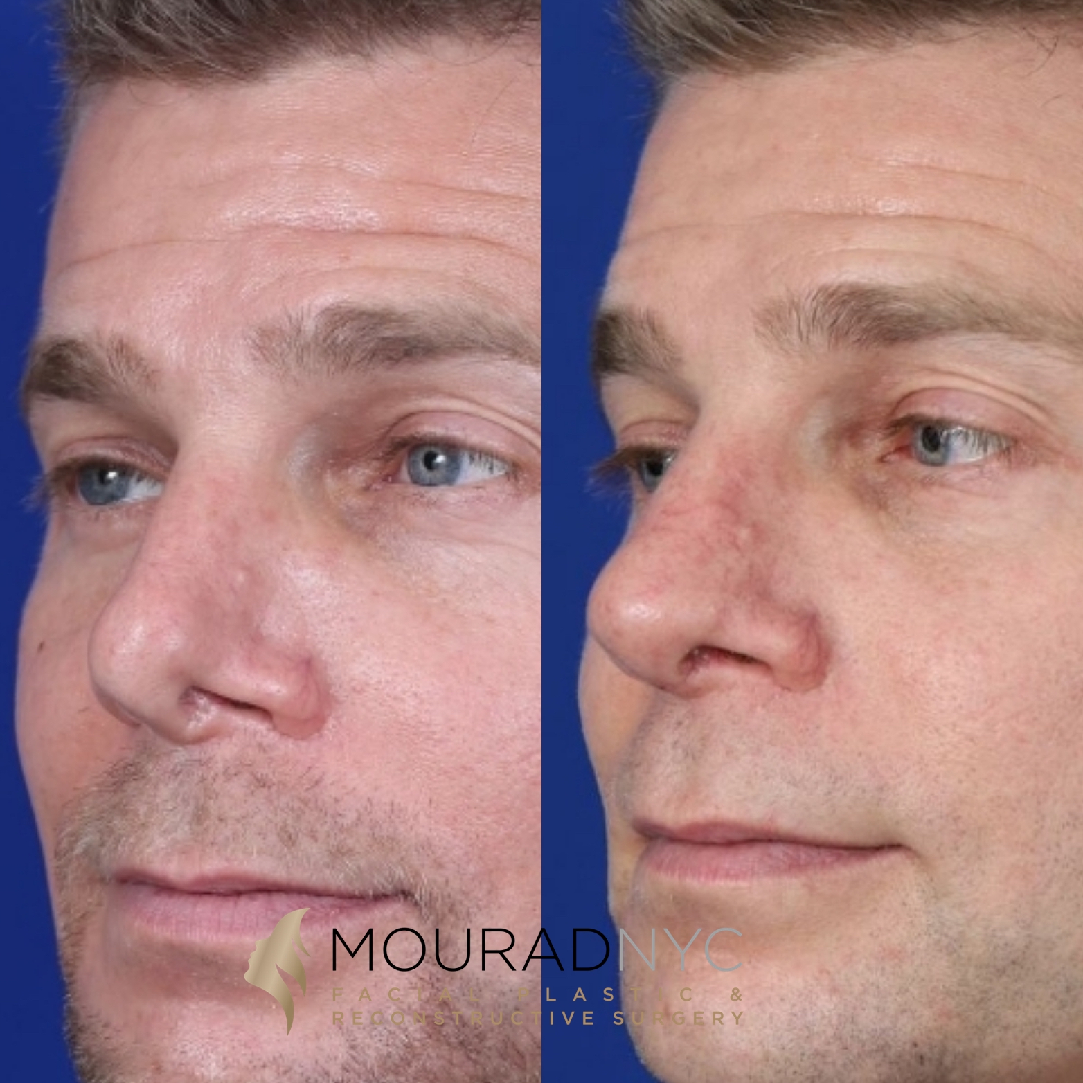 Male Revision Rhinoplasty Before and After Male Revision Rhinoplasty Before and After