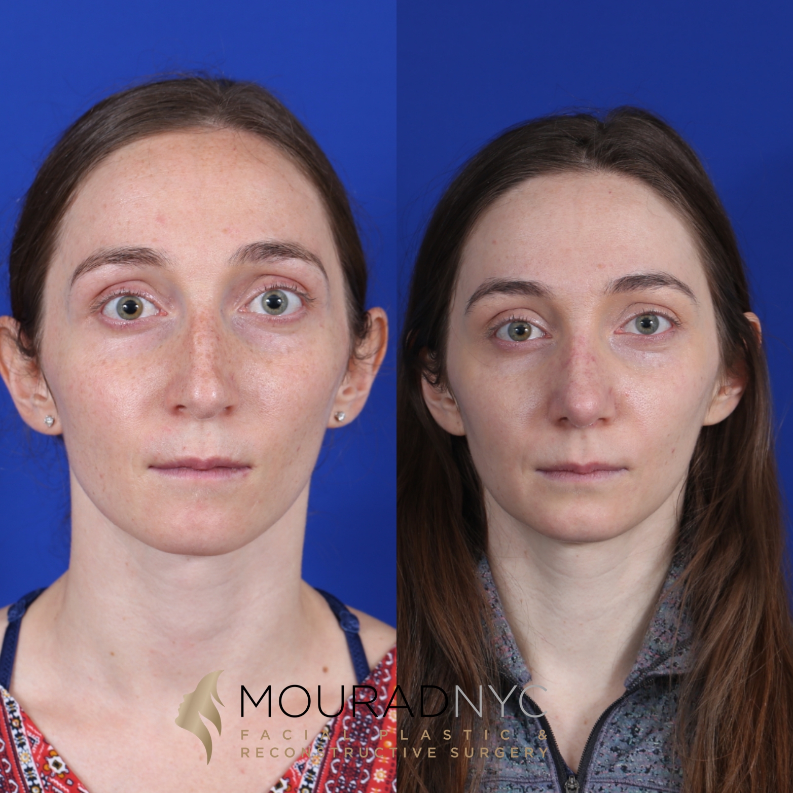 Female Closed Rhinoplasty Before and After Female Closed Rhinoplasty Before and After