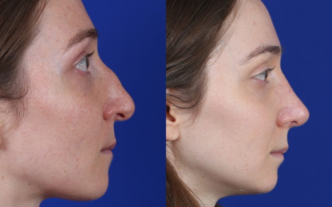 Female Closed Rhinoplasty Before and After