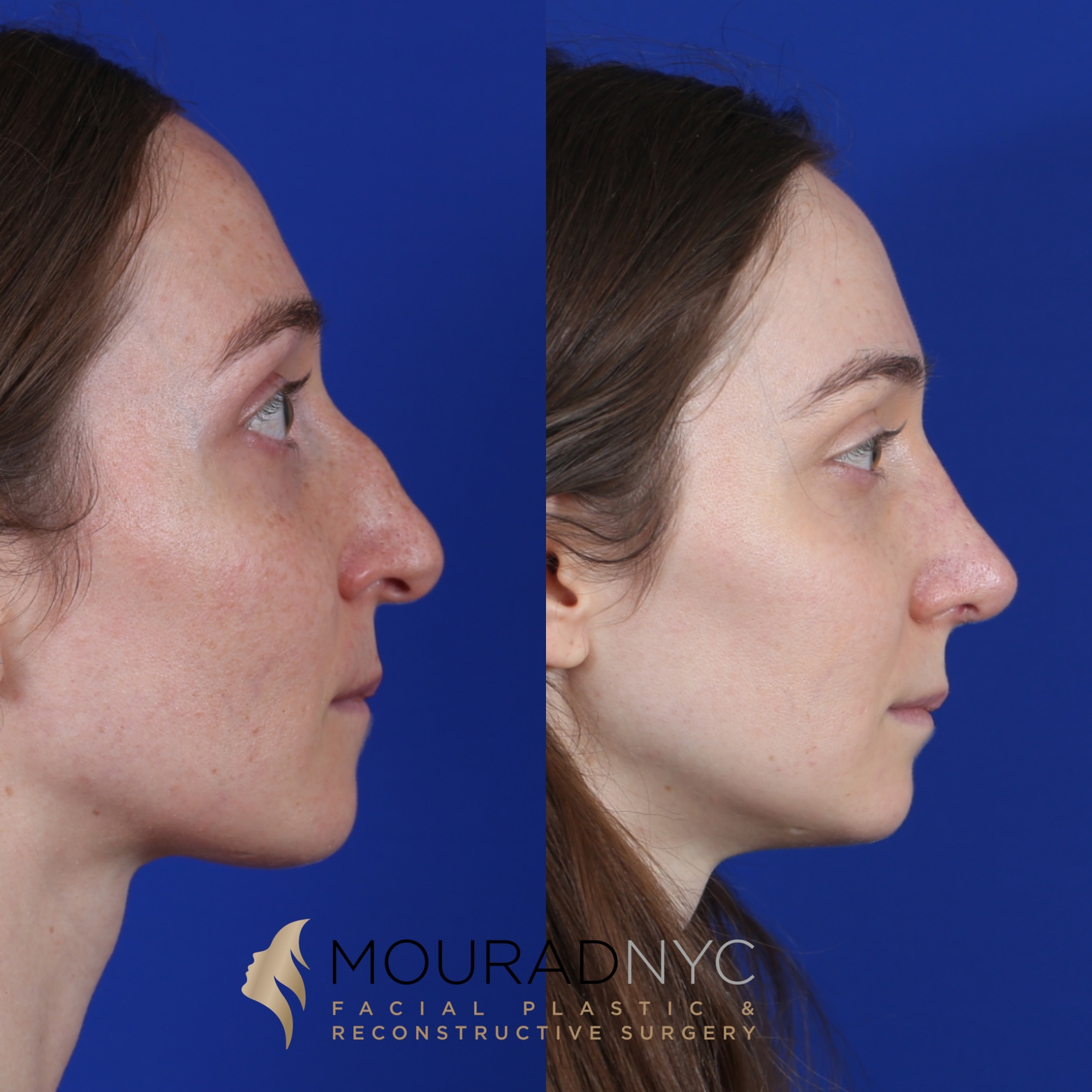 Female Closed Rhinoplasty Before and After Female Closed Rhinoplasty Before and After