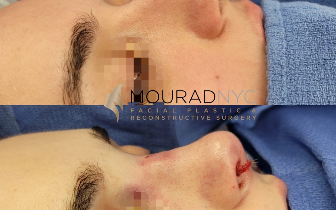 Female Closed Rhinoplasty Before and After
