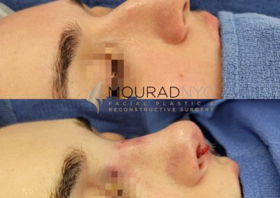 Female Closed Rhinoplasty Before and After