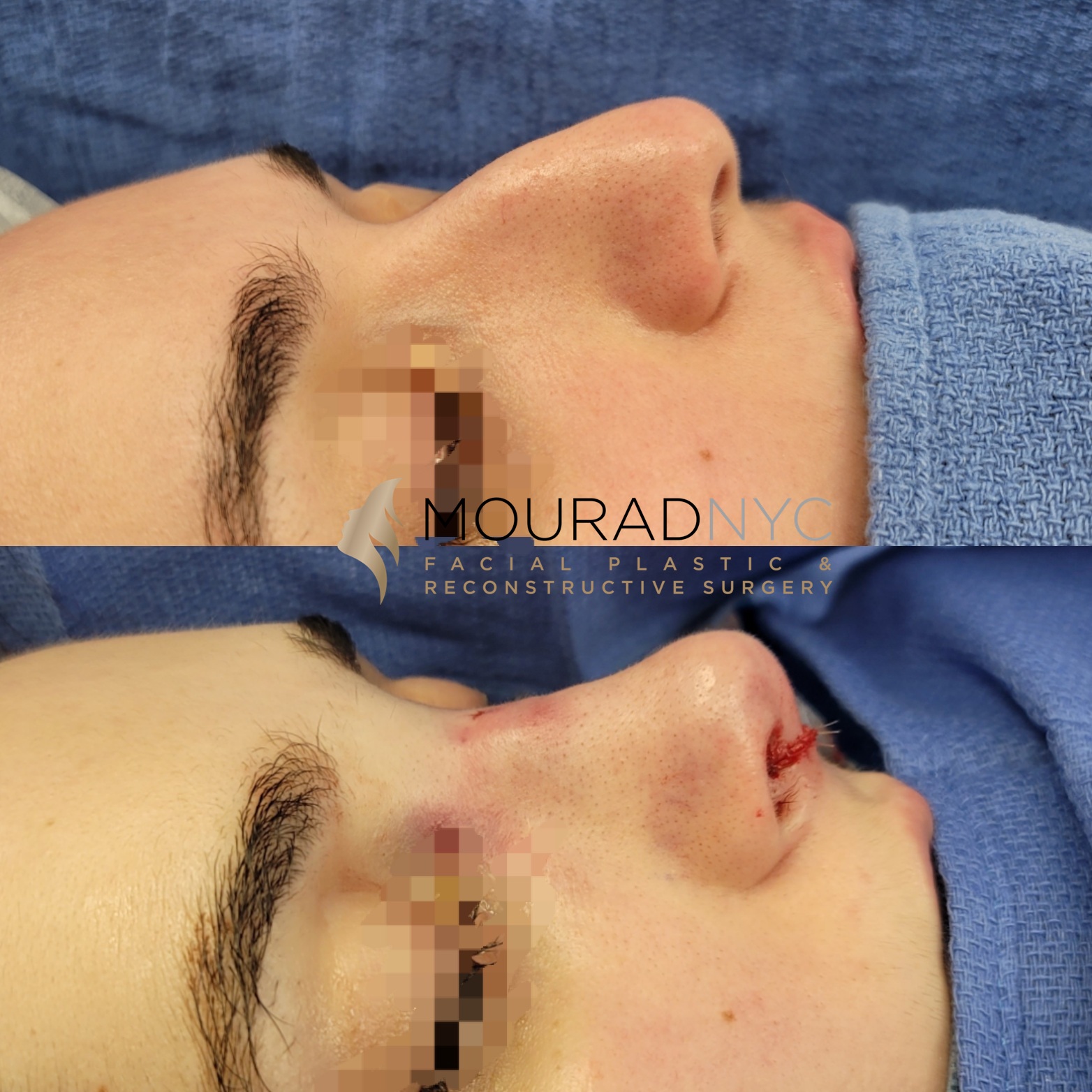 Female Closed Rhinoplasty Before and After Female Closed Rhinoplasty Before and After