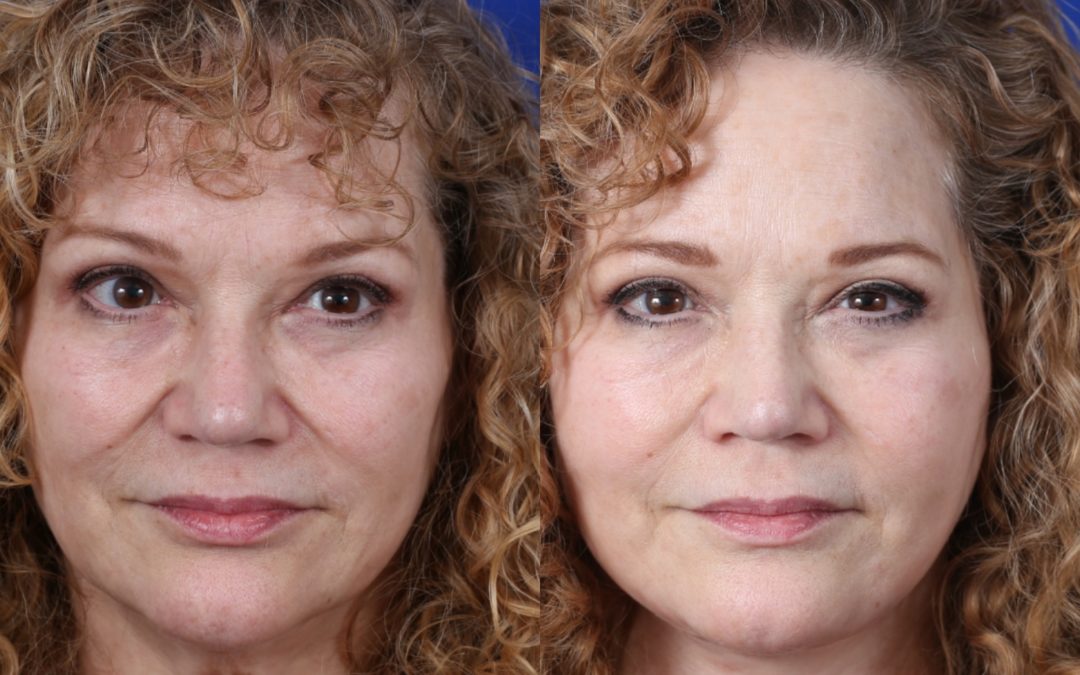 Female Facelift And Necklift Before And After
