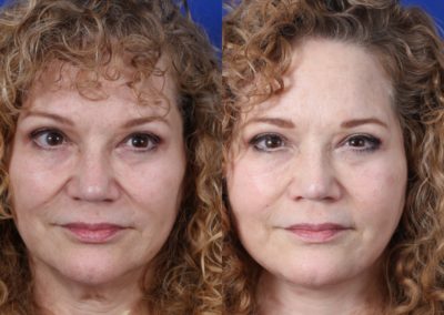 Female Facelift And Necklift Before And After