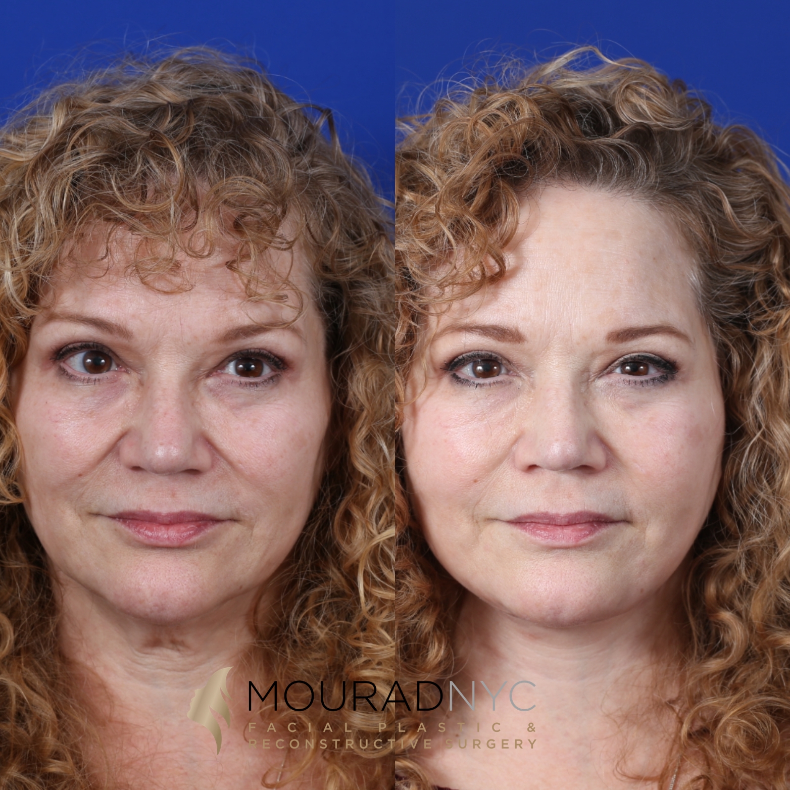 Female Facelift And Necklift Before And After Female Facelift And Necklift Before And After