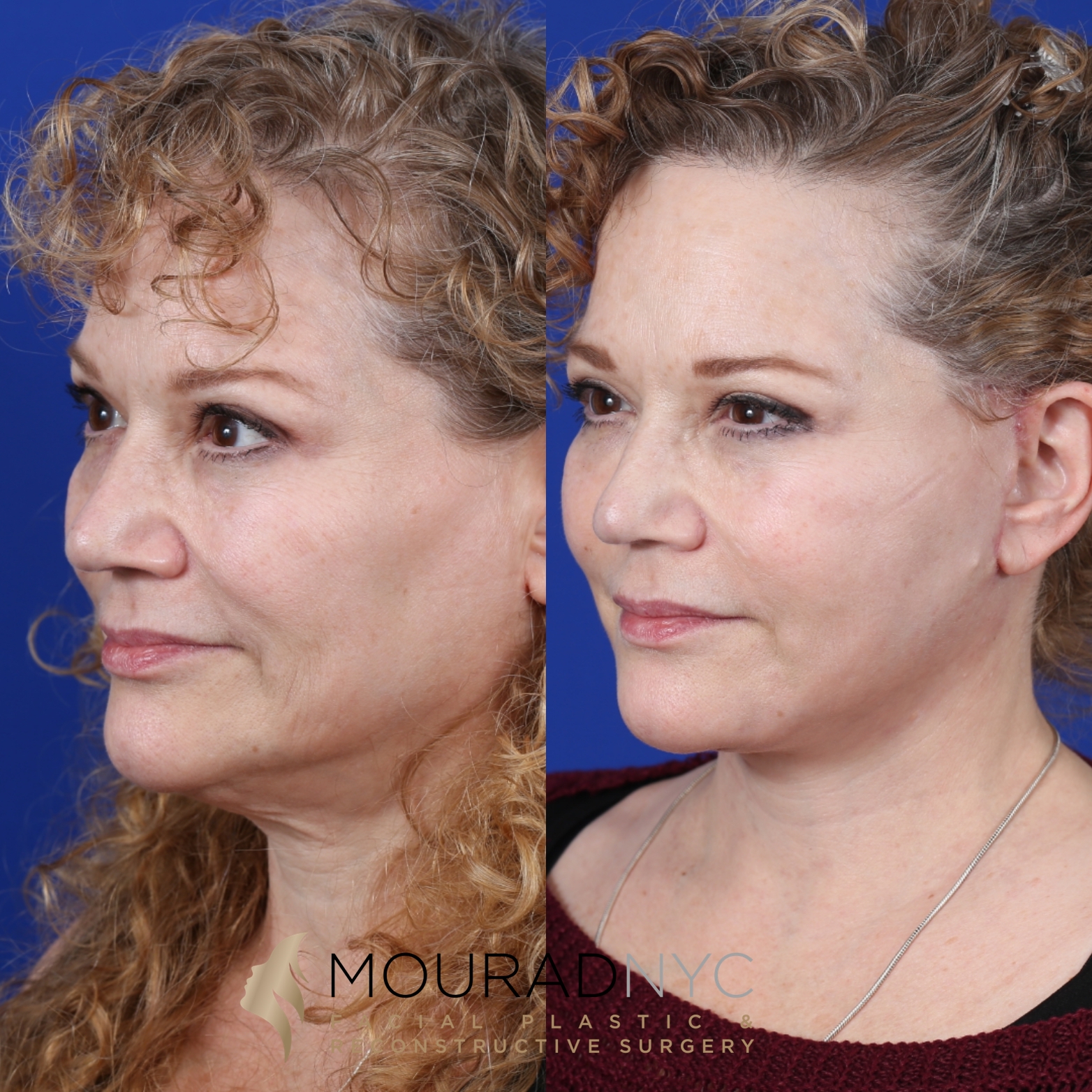 Female Facelift And Necklift Before And After Female Facelift And Necklift Before And After