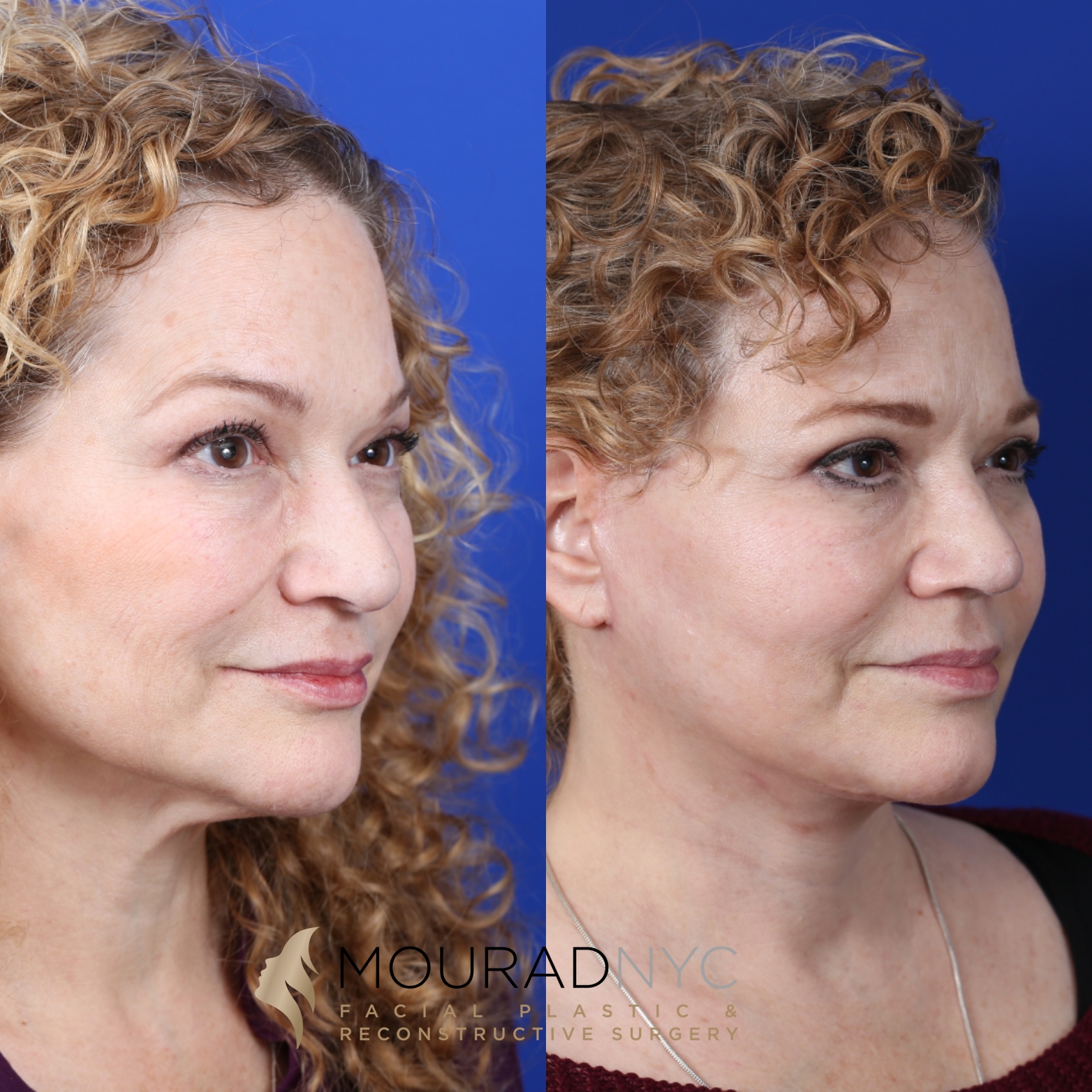 Female Facelift And Necklift Before And After Female Facelift And Necklift Before And After
