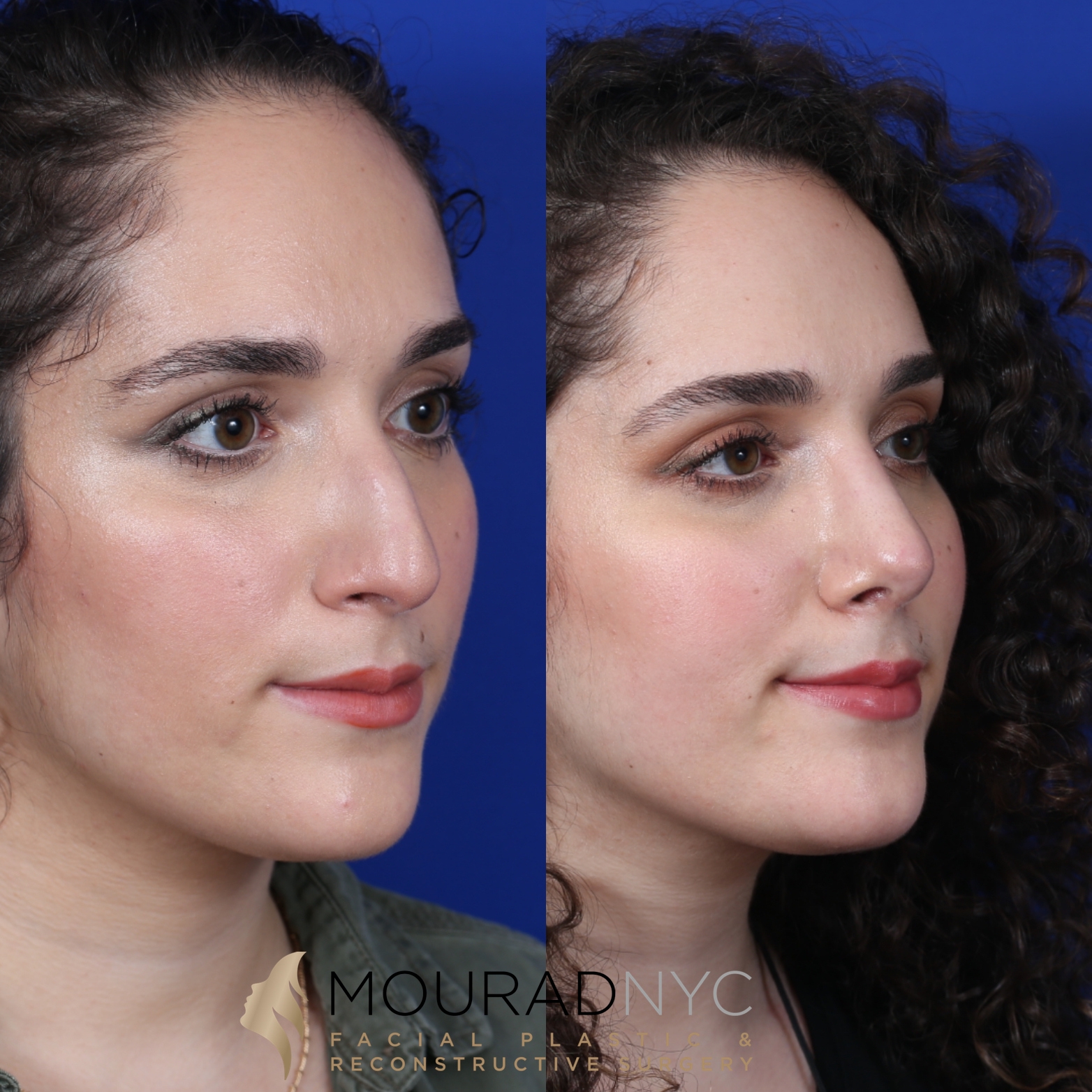 Female Closed Rhinoplasty Before and After