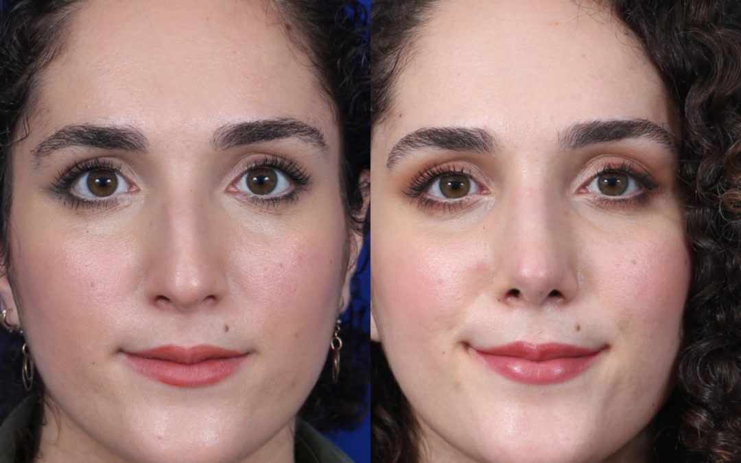 Female Closed Rhinoplasty Before and After